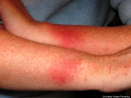 tape allergie symptomen