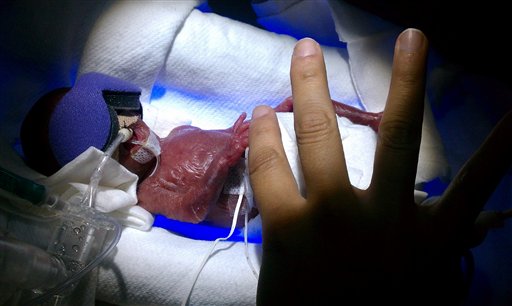 
 This undated photo provided by Los Angeles County-USC Medical Center shows shows Melinda Guido shortly after her birth in late August with the hand of Dr. Rangasamy Ramanathan as a comparison. Melinda was born premature at 24 weeks weighing only 9.5 ounces. She's believed to be the second smallest baby to survive in the United States and third in the world. (AP Photo/Los Angeles County-USC Medical Center )
 